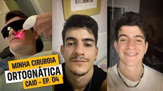 Cirurgia Ortognática - Microssomia Hemifacial - EP. 04