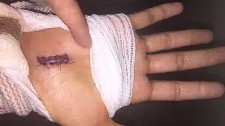 Carpal Tunnel Surgery Day 1