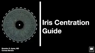 Repair of traumatic iris defect with fiber free artificial iris using centration guide