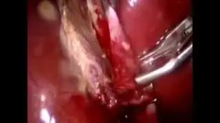 Colecistectomia Vieolaparaoscopica en Esferocitosis