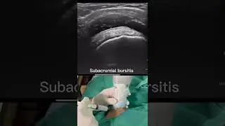 US guided subacromial steroid injection