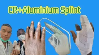 Closed Reduction with On Aluminium Splint