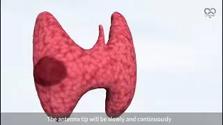 Thyroid ablation  Canyon MWA