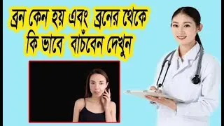 হরমোনঘটিত ব্রণ Hormonal Acne  হরমোনের তারতম্যে ব্রণের সমস্যার প্রাকৃতিক প্রতিকার (health tips )