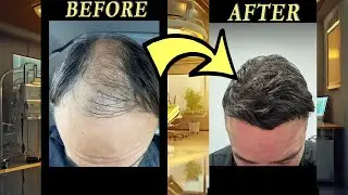 These Hair Transplant Results Are Just INSANE !
