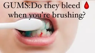 Are your gums BLEEDING 🩸?Here’s the reason why #gumdisease #teeth #study #fyp