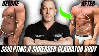 ATHLETIC WITHOUT ABS? TRY THE ULTIMATE GLADIATOR LIPO FOR FINE DETAILS | Dr. Jason Emer