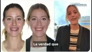 Cirugía bimaxilar Caso #148: Alejandra - Clase III, cara larga, hipoplasia maxilar
