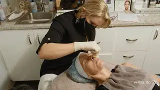 VI Peel Treatment | Derms of Boca Raton | Nancy Rozs