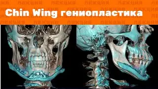 Лекция: Chin Wing гениопластика