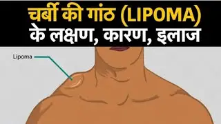 Multiple lipoma in Girls चर्बी की गांठ का घरेलू इलाज, क्यों बनती है? लिपोमा की दवा,सर्जरी में खर्चा