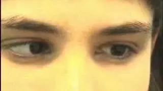 Nystagmus examination.WMV