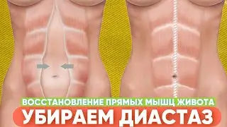 ДИАСТАЗ / Эффективная схема тейпирования #убираемживот