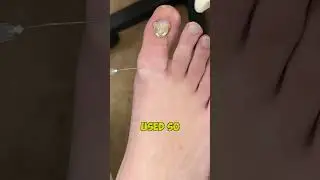 Does it hurt to have an ingrown toenail removed? 