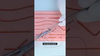 Teknik Jahit Luka: Flap Triangular