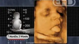 Fetus 7 1/2 months -- Breathing Movements