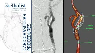 Transcarotid Artery Revascularization (A. Lumsden, MD, P. Osztrogonacz, MD, Y. Chauhan, MD)