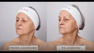 Jak prawidłowo wykonać zabieg ZAFFIRO, aby uzyskać fenomenalne efekty po pierwszym zabiegu?