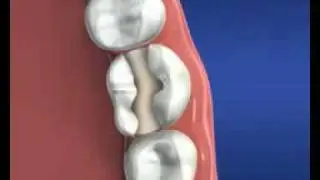Пломбировка зуба
