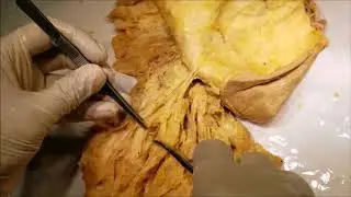 Female Mammary Architecture Demonstration – Breast Cancer and Mastectomy Principle – Sanjoy Sanyal