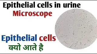 Causes of Epithelial Cells in Urine I Epithelial cells in urine