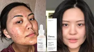 5 ЛЮБИМЫХ СРЕДСТВ ОТ THE ORDINARY|ПОМОГЛИ ВЫЛЕЧИТЬ КОЖУ