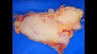 濾胞性リンパ腫