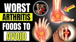 The 5 Worst Foods you should Avoid if you Have Arthritis and Joint Pain