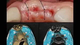 Best Flap Designs for Implant Surgery