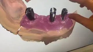 Skenování implantátů pomocí skenovacích tělísek