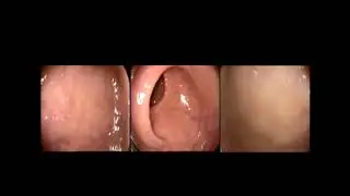 פרופסור איאן גרלנק - גסטרוסקופיה וקולונוסקופיה בטכנולוגיה החדשנית של ה-FUSE
