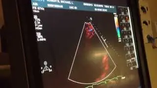 My Hear ECHO ( Echocardiogram )