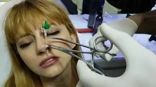 Burun Nose Piercing Sonrası Bakım Ve ÖNERI ??