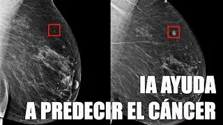 Usan IA para predecir el cáncer