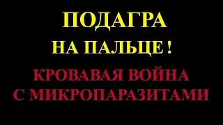Подагра пальца. Мои опыты.