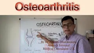 Osteoarthritis