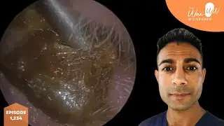 1,234 - Blocked Plug of Ear Wax Removal with Microsuction