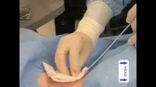 US Guided I J V Cannulation NEJM