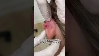 Szövetszaporulat eltávolítása helix piercing mögül