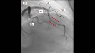 Myocardial Bridge as a Cause of Exertional Chest Pain