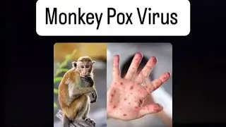 Monkey pox - Transmission, symptoms & treatment, Prevention || Mis.Medicine_DrGarima