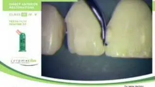 Ceram X duo: Restauración de anteriores Dr. Dietschi