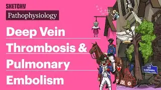 Deep Vein Thrombosis & Pulmonary Embolism (Pathophysiology) | Sketchy Medical
