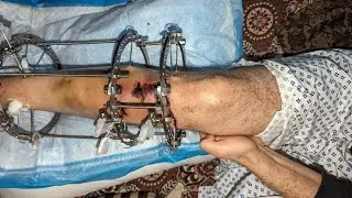 Ilizarov Surgery Wound Dressing: Up Close & Demystified!