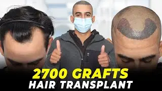 Hair Transplant in Khandwa | Best Results & Cost of Hair Transplant in Khandwa