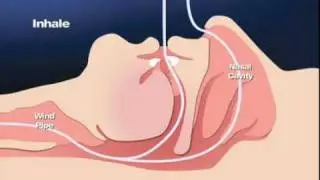 ORA offering AveoTSD Snoring and Sleep Apnea Oral Appliance