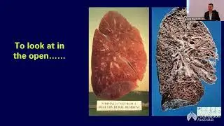 What is PF/ILD: Disease pathways and treatment