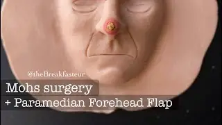 Playdough Surgery 🔪👃🏻 - Mohs surgery and Paramedian Forehead Flap
