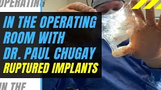 Ruptured Breast Implants - Should Implants Be Replaced After 10 Years?