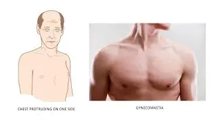 CHEST PROTRUDING ON ONE SIDE & GYNECOMASTIA
